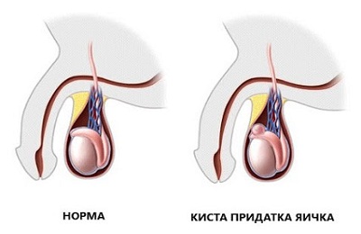 Образование кисты