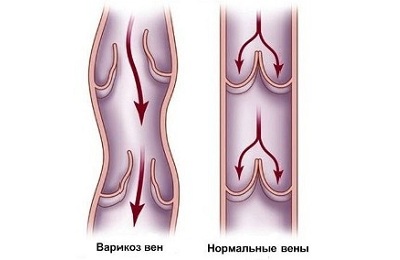 Заболевание вен