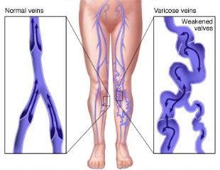 Варикоз