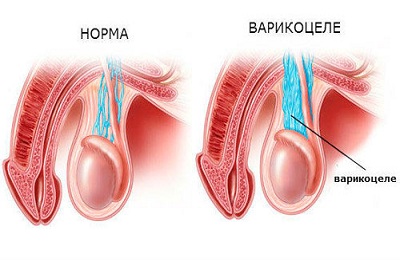 Заболевание мошонки
