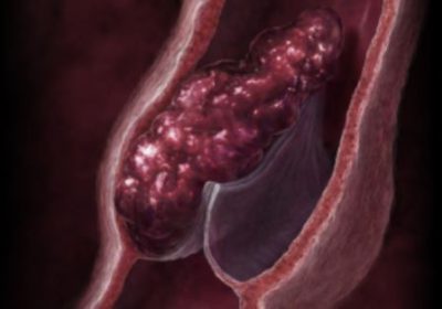 Тромб в вене