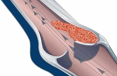 Образование тромба