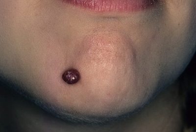 Образование на подбородке