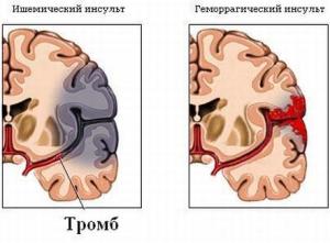 Геморрагический и ишемический инсульт