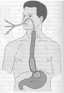 зонд Сенгштакена-Блекмора