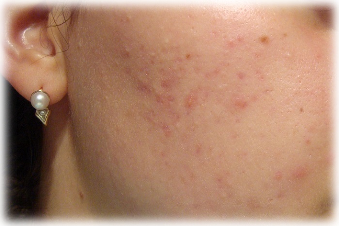 1 степень акне