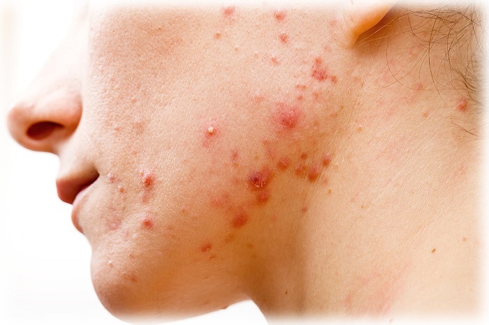 2 степень акне