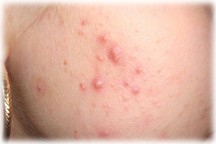 Фото акне на щеках