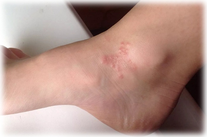 Акне на ногах