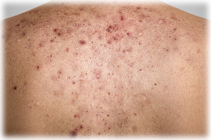 Фото акне на спине