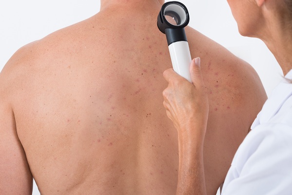 Диагностика акне на спине