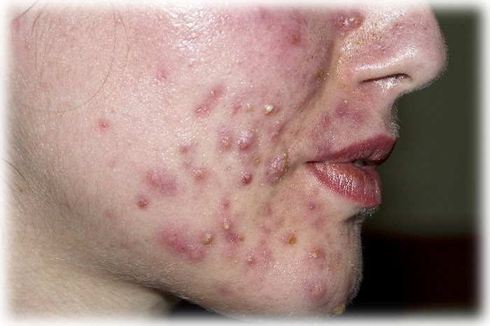 Фото акне у пожилой женщины