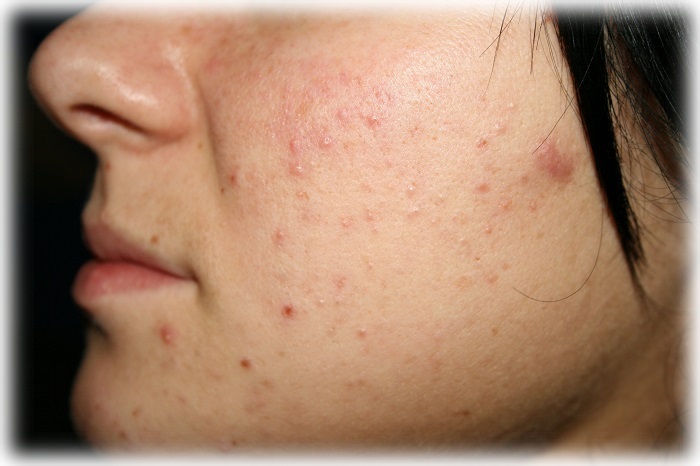 Фото акне у молодой женщины