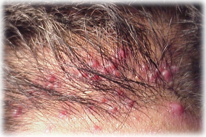 Акне на голове под волосами