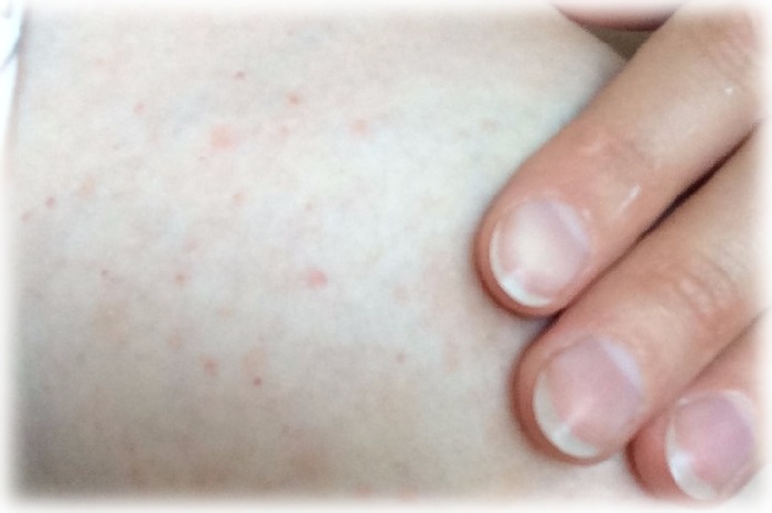 Акне на груди у женщины