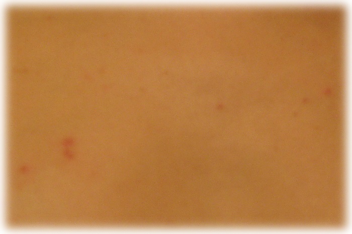 Сыпь на груди