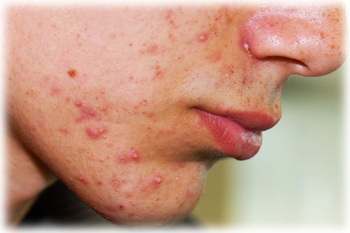 Проявление акне у мужчины