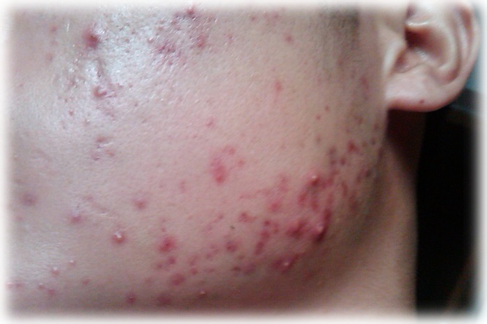 Фото, как выглядит акне у мужчин