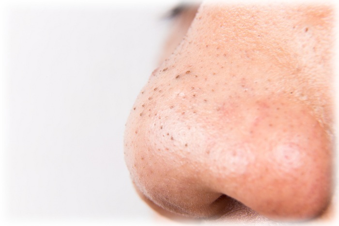 Фото акне на носу