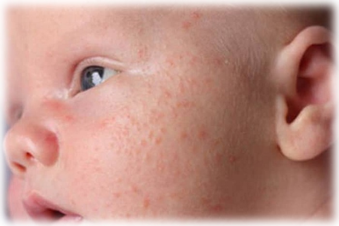 Фото новорожденного с акне