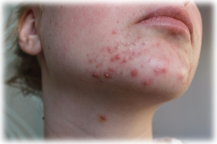 Фото акне на подбородке