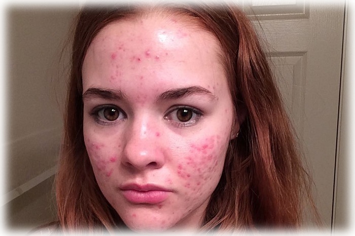 Фото подросткового акне