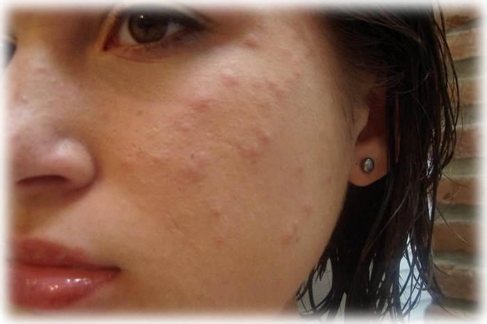 Фото акне у взрослой женщины