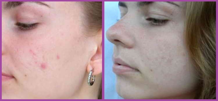 Фото результата от применения борной кислоты для лица