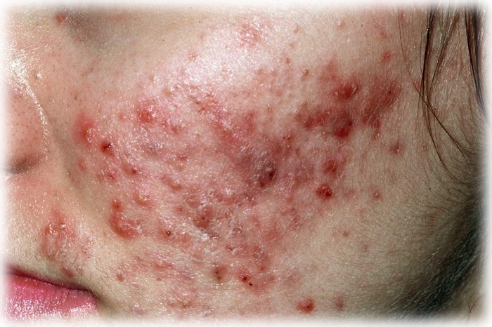 4 степень акне