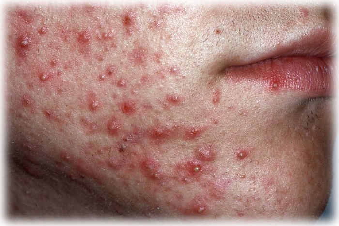 3 стадия акне