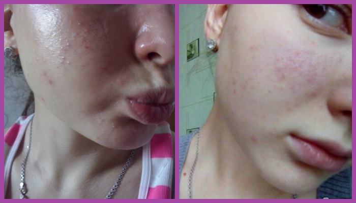 Фото с результатами лечения прыщей Циндолом