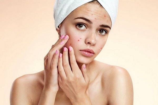 Как выглядит гормональное акне?