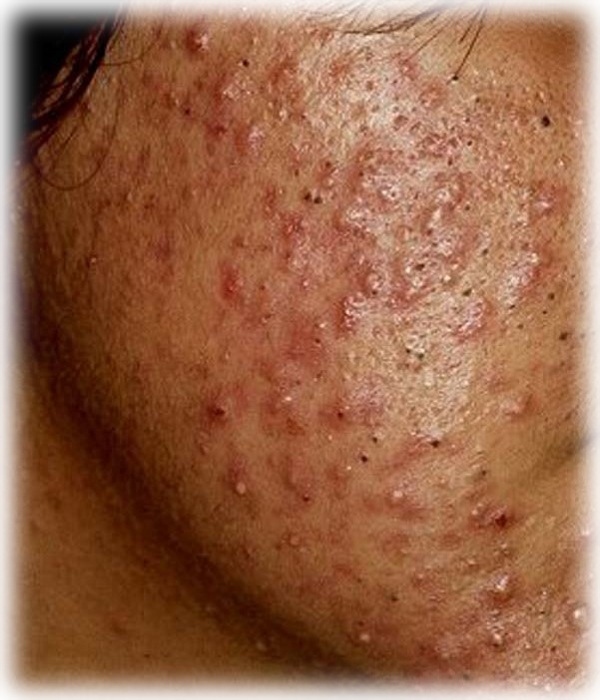 Кистозное акне на лице