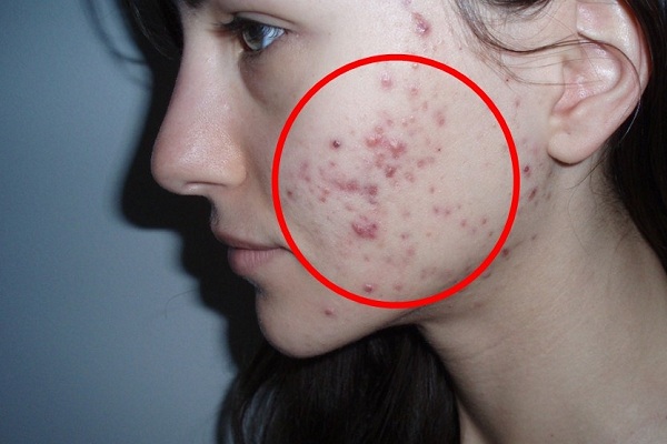 Кистозные угри у девушек