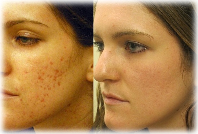 Фото ДО и ПОСЛЕ лечения акне лазером