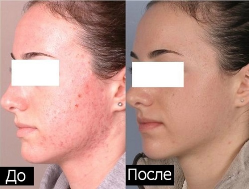 Фото ДО и ПОСЛЕ использования магнитной маски