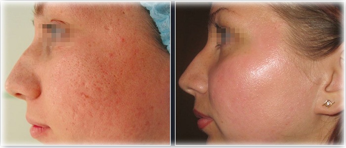 Результат от мезотерапии