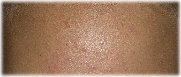 Фото закрытых комедонов