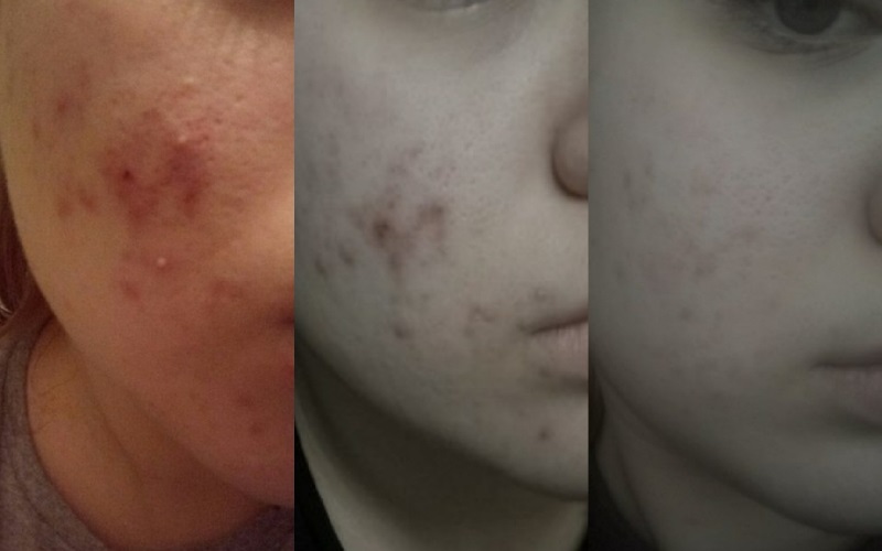 Эффективность лечения прыщей Зеркалином