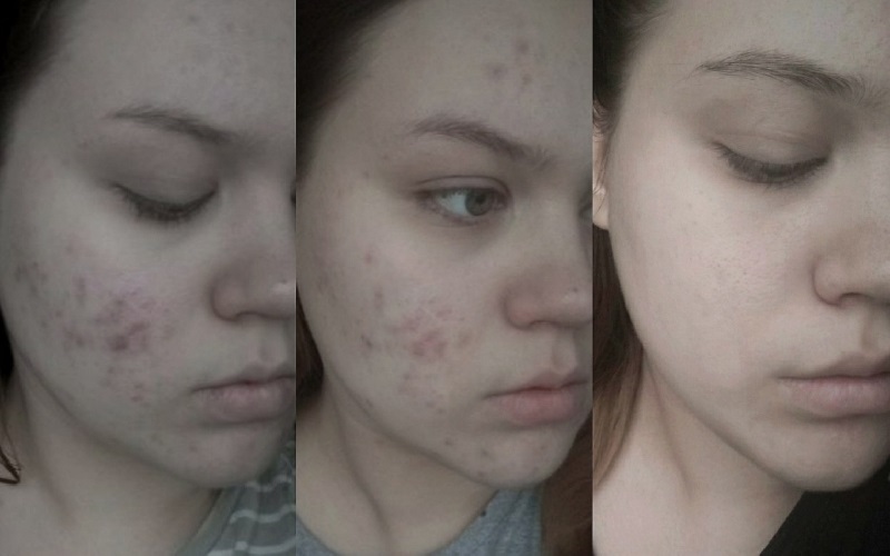 Фото ДО и ПОСЛЕ применения Зеркалина