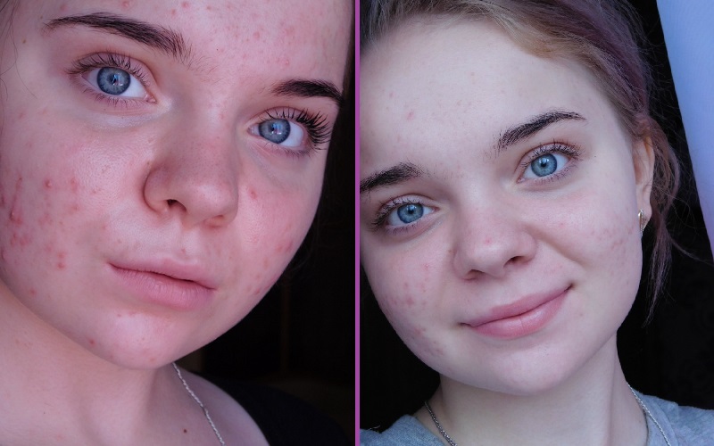 Фото ДО и ПОСЛЕ использования лосьона Зеркалин