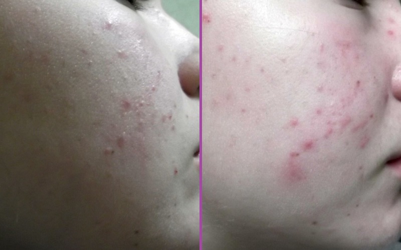 Эффективность Зеркалина