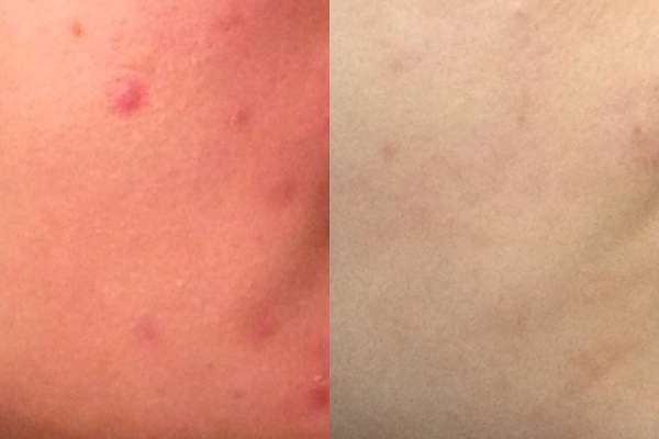 Фото ДО и ПОСЛЕ Зинерита