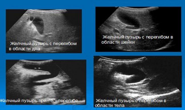 Загиб желчного пузыря