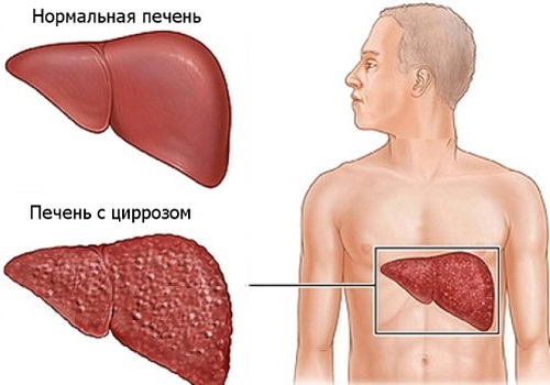 Фиброз печени: симптомы, степени, формы, причины, лечение и прогноз