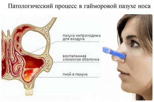 Лучший способ лечения искривления носовой перегородки