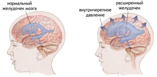 Внутричерепное давление у ребенка 4 месяца симптомы и лечение