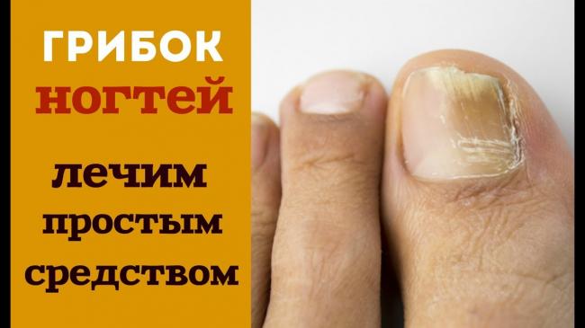 Причины ребристых ногтей на руках