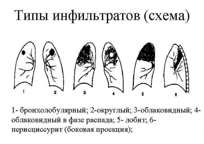 Туберкулез легких (очаговый и инфильтративный)