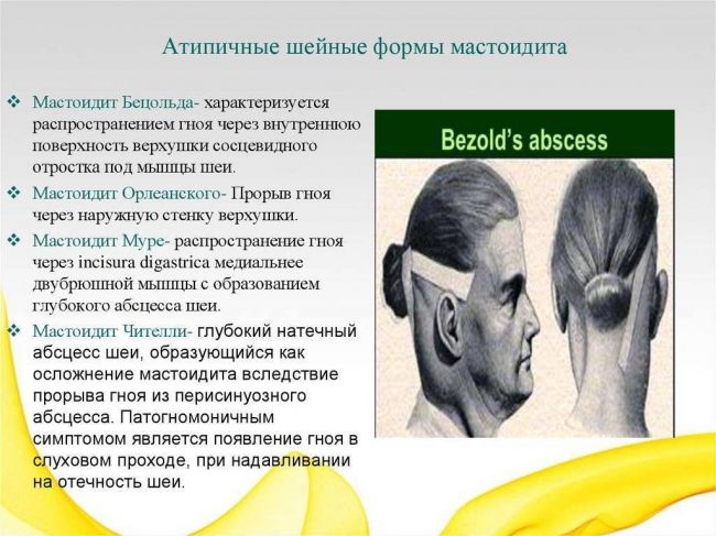 Отомастоидит (мастоидит) — что это такое?